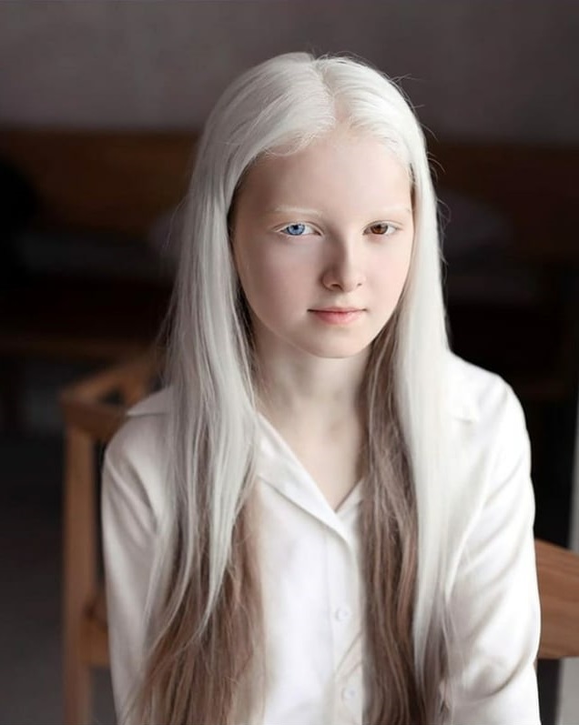 Белоснежная особенность : 19 фотоснимков людей с альбинизмом, доказывающих, что это красиво